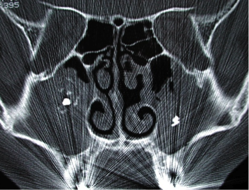 Aspect au scanner de champignons dans les sinus maxillaires